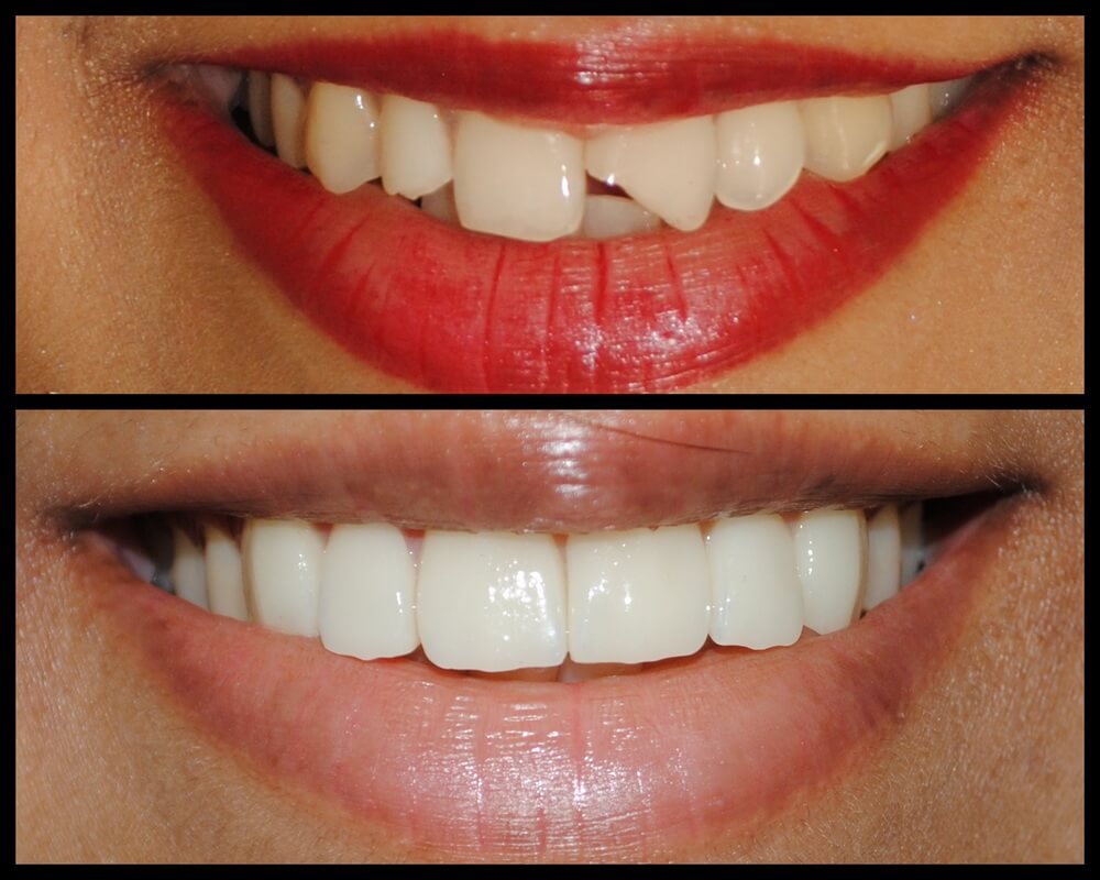 دندانپزشکی زیبایی - کامپوزیت دندان
